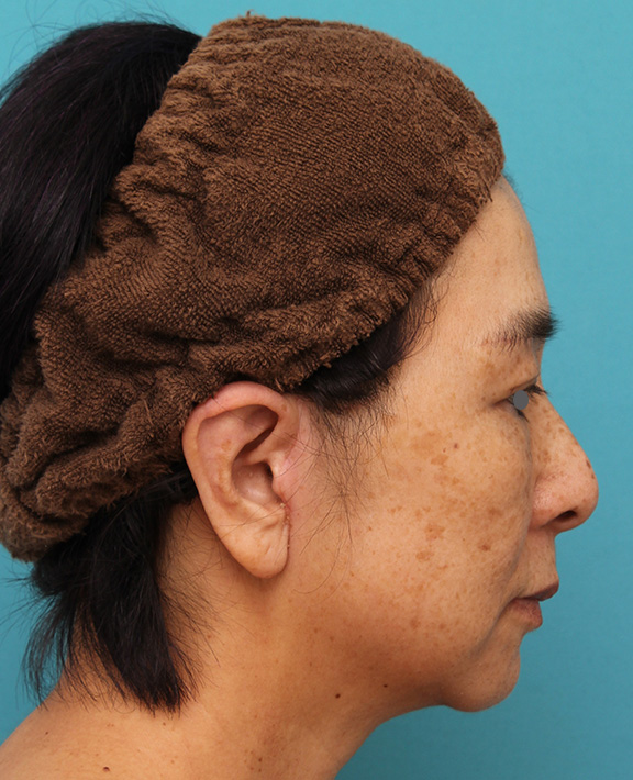 症例写真,ミディアムフェイスリフトで頬のたるみをリフトアップさせた50代後半女性の症例写真,After(6ヶ月後),ba_mediumlift008_b03.jpg