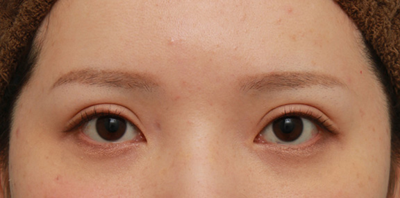 症例写真,患者様の希望で二重まぶたミニ切開法で幅の広い平行型二重を作った症例写真,After(2年後のメイクありの状態),