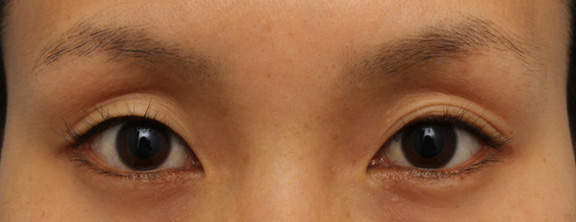 埋没法でナチュラルな平行二重を作った症例写真,Before,ba_maibotsu042_b01.jpg
