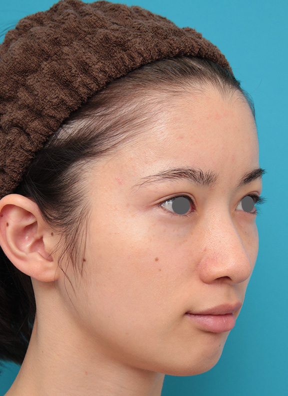 症例写真,人工骨セメントで額形成手術を行い、平らなおでこをぽっこり丸くした症例写真,After(2ヶ月後),ba_hitaicement002_b02.jpg