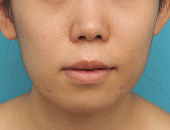 症例写真,上下の厚い唇を口唇縮小手術で薄くした症例写真,After(6ヶ月後),ba_usuku009_b02.jpg