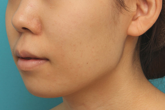 症例写真,上下の厚い唇を口唇縮小手術で薄くした症例写真,After(6ヶ月後),ba_usuku009_b04.jpg