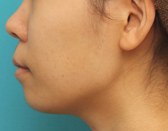 症例写真,上下の厚い唇を口唇縮小手術で薄くした症例写真,After(6ヶ月後),ba_usuku009_b05.jpg
