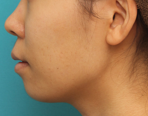 症例写真,上下の厚い唇を口唇縮小手術で薄くした症例写真,After(6ヶ月後),ba_usuku009_b06.jpg