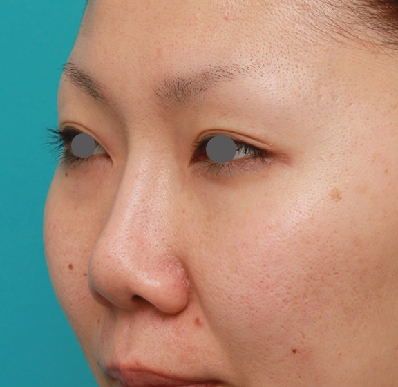 症例写真,他院で受けた鼻の手術の修正(プロテーゼ入れ替え+耳介軟骨移植+小鼻縮小)の症例写真,Before,ba_nose_modify022_b02.jpg