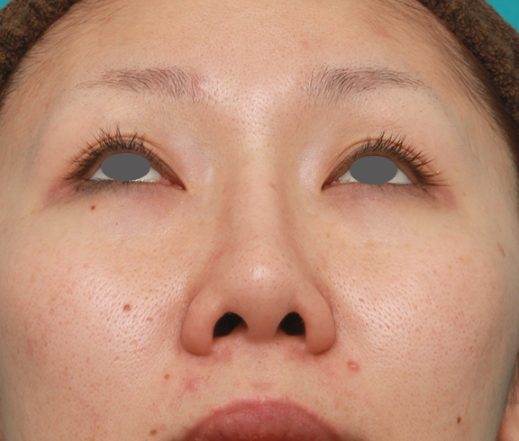 症例写真,他院で受けた鼻の手術の修正(プロテーゼ入れ替え+耳介軟骨移植+小鼻縮小)の症例写真,Before,ba_nose_modify022_b04.jpg