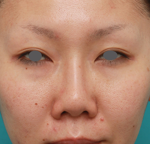 症例写真,他院で受けた鼻の手術の修正(プロテーゼ入れ替え+耳介軟骨移植+小鼻縮小)の症例写真,当院来院時(修正手術前) ,mainpic_nose_modify022a.jpg