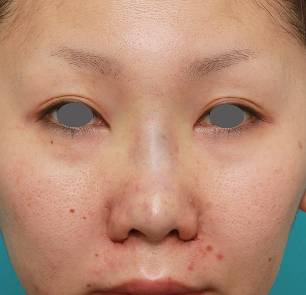 症例写真,他院で受けた鼻の手術の修正(プロテーゼ入れ替え+耳介軟骨移植+小鼻縮小)の症例写真,修正手術直後,mainpic_nose_modify022b.jpg