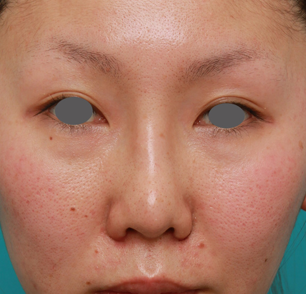 症例写真,他院で受けた鼻の手術の修正(プロテーゼ入れ替え+耳介軟骨移植+小鼻縮小)の症例写真,1週間後,mainpic_nose_modify022c.jpg
