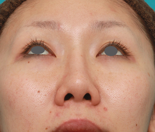 症例写真,他院で受けた鼻の手術の修正(プロテーゼ入れ替え+耳介軟骨移植+小鼻縮小)の症例写真,当院来院時(修正手術前),mainpic_nose_modify022e.jpg
