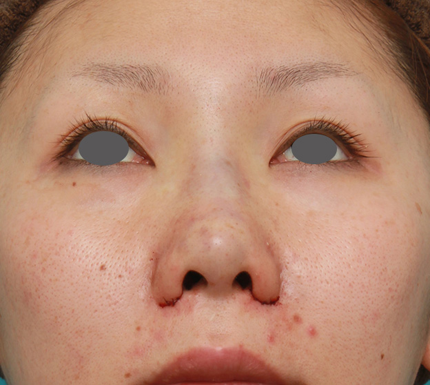 症例写真,他院で受けた鼻の手術の修正(プロテーゼ入れ替え+耳介軟骨移植+小鼻縮小)の症例写真,修正手術直後,mainpic_nose_modify022f.jpg