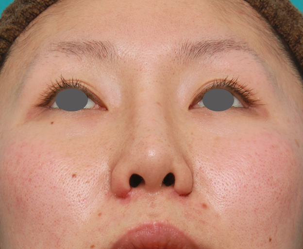 症例写真,他院で受けた鼻の手術の修正(プロテーゼ入れ替え+耳介軟骨移植+小鼻縮小)の症例写真,1週間後,mainpic_nose_modify022g.jpg