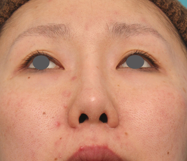 症例写真,他院で受けた鼻の手術の修正(プロテーゼ入れ替え+耳介軟骨移植+小鼻縮小)の症例写真,6ヶ月後,mainpic_nose_modify022h.jpg