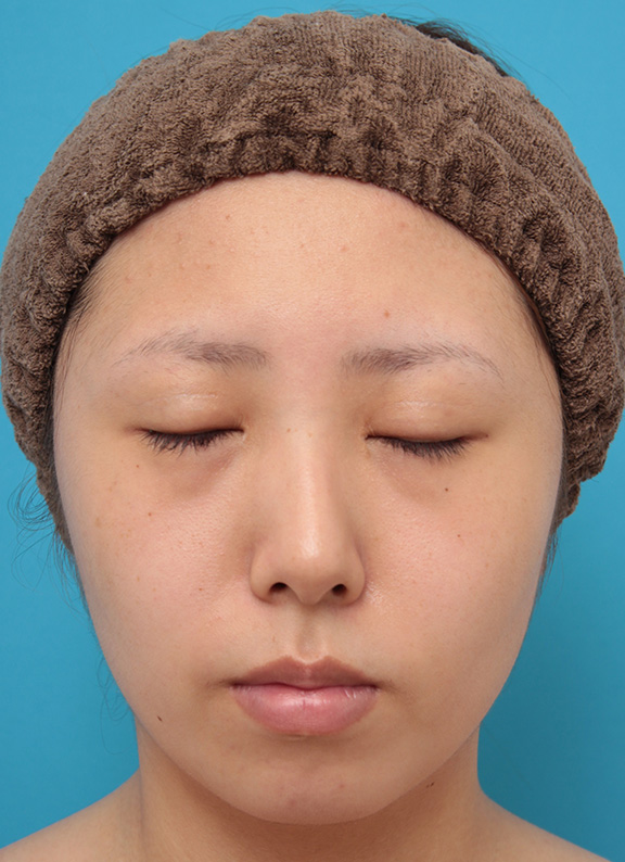 症例写真,患者様の希望で超幅広平行型二重を全切開法で行い、同時に目頭切開、目尻切開、タレ目形成を行った症例写真,After(6ヶ月後),ba_sekkai061_b02.jpg