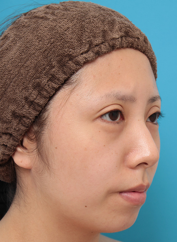 症例写真,患者様の希望で超幅広平行型二重を全切開法で行い、同時に目頭切開、目尻切開、タレ目形成を行った症例写真,After(6ヶ月後),ba_sekkai061_b03.jpg