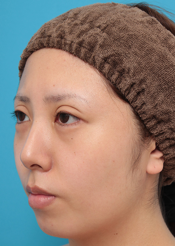 症例写真,患者様の希望で超幅広平行型二重を全切開法で行い、同時に目頭切開、目尻切開、タレ目形成を行った症例写真,After(6ヶ月後),ba_sekkai061_b04.jpg