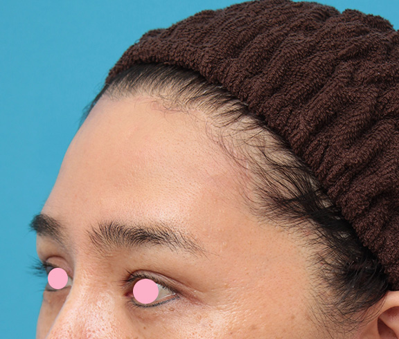 症例写真,髪の毛の生え際で切開する額リフトでおでこのシワを伸ばした症例写真,After(6ヶ月後),ba_hitailift003_b02.jpg