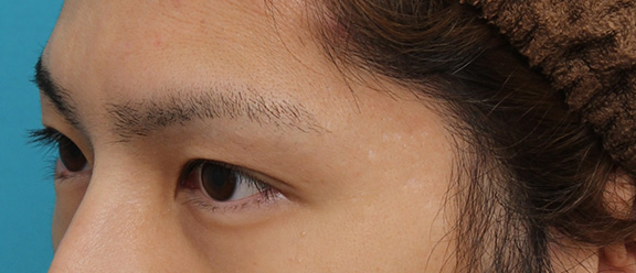 症例写真,二重全切開法の症例写真,After(3ヶ月後),ba_sekkai064_b02.jpg