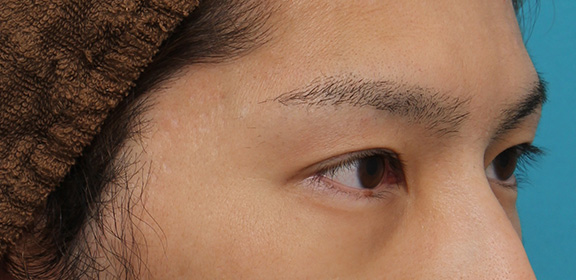 症例写真,二重全切開法の症例写真,After(3ヶ月後),ba_sekkai064_b03.jpg