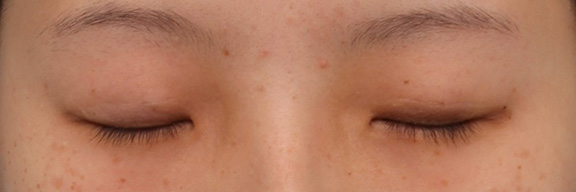症例写真,10代女性に埋没2針固定を行い、ナチュラルな平行二重にした症例写真,After(3ヶ月後目を閉じた状態),