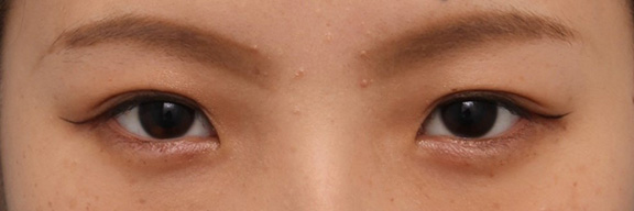 症例写真,10代女性に埋没2針固定を行い、ナチュラルな平行二重にした症例写真,After(3ヶ月後メイクあり),
