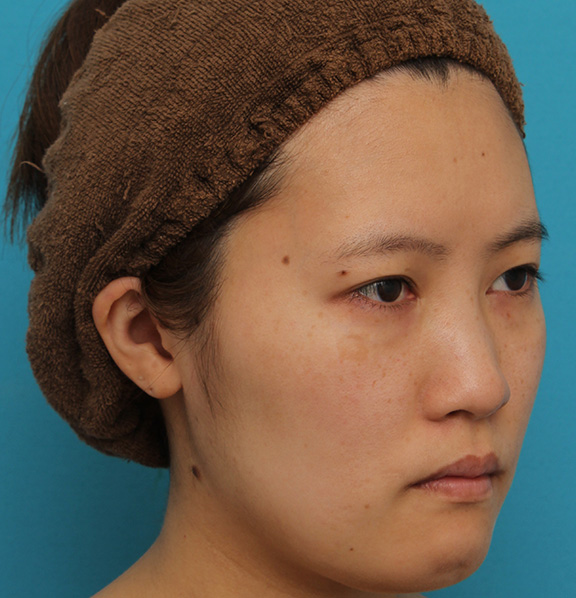 ミニフェイスリフト(頬のたるみ取り),ミニフェイスリフトの症例 20代女性の頬を中心としたお顔のたるみの改善,Before,ba_minilift007_b02.jpg