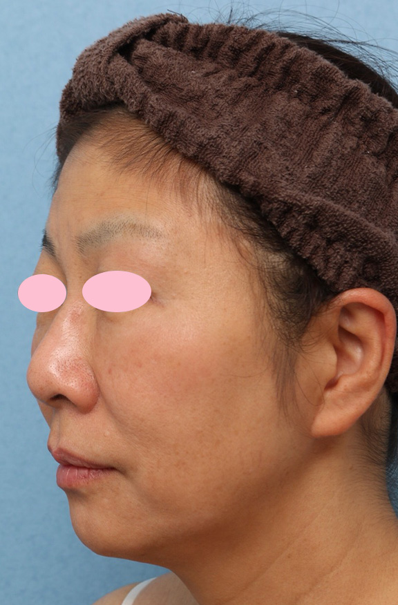 症例写真,ヒアルロン酸3本ですっきりVシェイプリフトした症例写真,After(2週間後),ba_v_shapelift011_b02.jpg