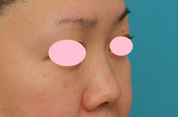症例写真,ヒアルロン酸による隆鼻術の症例写真,After(1ヶ月後),ba_ryubi2032_b02.jpg