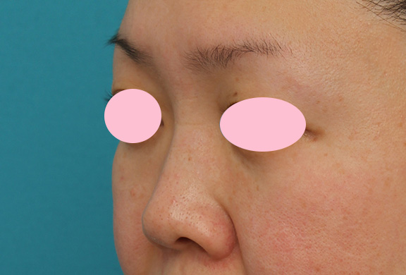 症例写真,ヒアルロン酸による隆鼻術の症例写真,After(1ヶ月後),ba_ryubi2032_b04.jpg