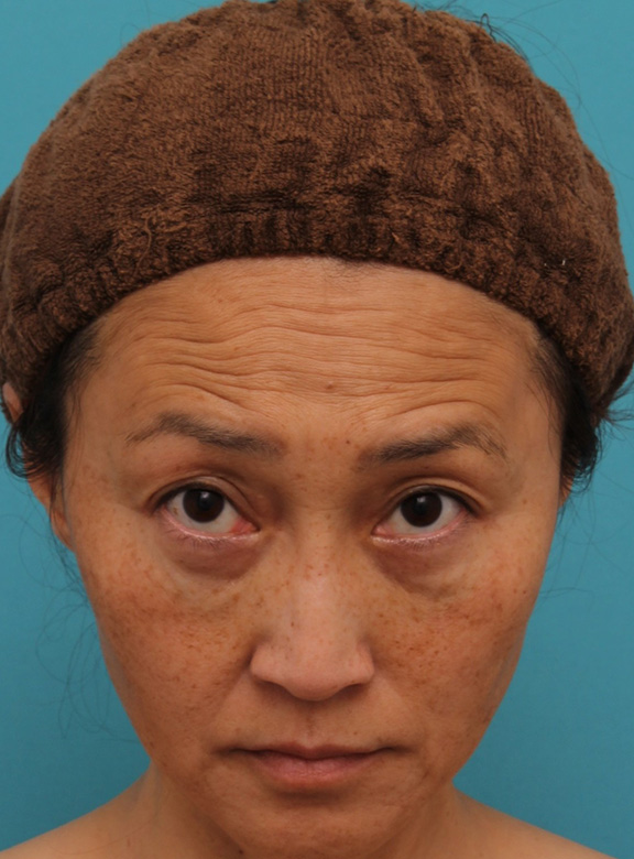 症例写真,40代女性の目の下をスッキリさせた症例写真,After(6ヶ月後),ba_shibo_under013_b02.jpg