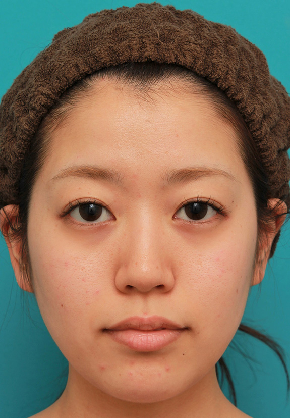 症例写真,メソシェイプフェイス(顔専用の脂肪溶解注射)で小顔になった20代女性の症例写真,After(3回注射後),ba_meso_face014_b01.jpg