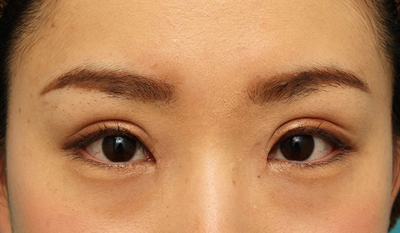 目頭切開,患者様の希望で幅広平行型二重を眼瞼下垂手術で作り、同時に目頭切開と目尻切開を行った症例写真,After(6ヶ月後のメイクあり),