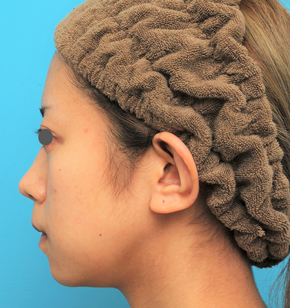 症例写真,人中短縮手術(リップリフト)を行った20代女性の症例写真,After(6ヶ月後),ba_hanashita005_b02.jpg