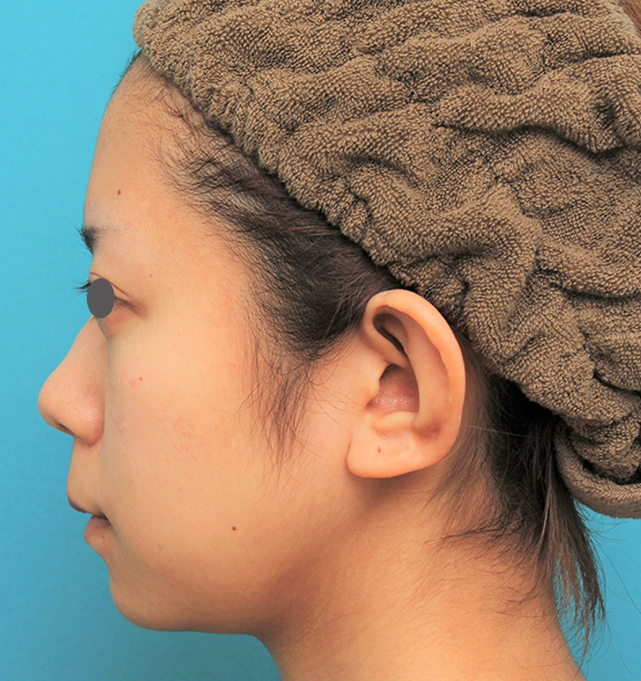 症例写真,人中短縮手術(リップリフト)を行った20代女性の症例写真,Before,ba_hanashita005_b02.jpg