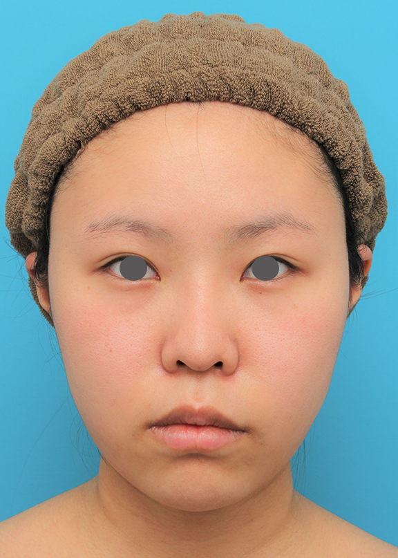 脂肪吸引（頬、あご下）,脂肪吸引,顔（頬～フェイスライン～顎下）の脂肪吸引をした20代女性の症例写真,After（6ヶ月後）,ba_shibo006_a01.jpg