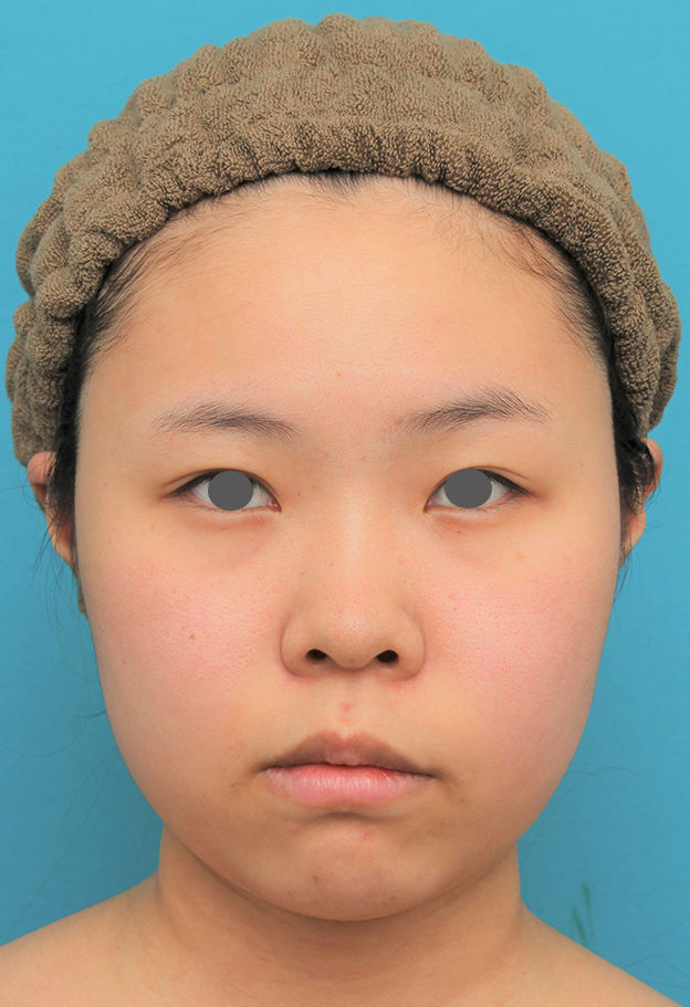 脂肪吸引（頬、あご下）,顔（頬～フェイスライン～顎下）の脂肪吸引をした20代女性の症例写真,手術前,mainpic_shibo006a.jpg