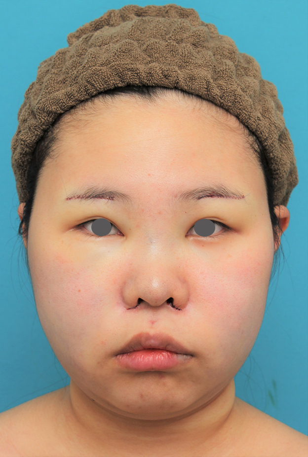 脂肪吸引（頬、あご下）,顔（頬～フェイスライン～顎下）の脂肪吸引をした20代女性の症例写真,手術直後,mainpic_shibo006b.jpg