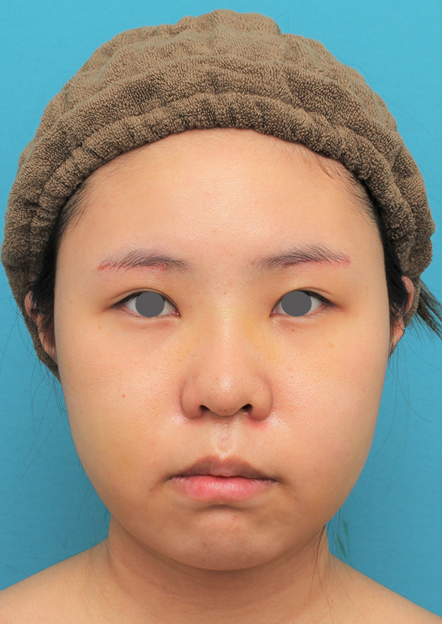 脂肪吸引（頬、あご下）,顔（頬～フェイスライン～顎下）の脂肪吸引をした20代女性の症例写真,6日後,mainpic_shibo006c.jpg