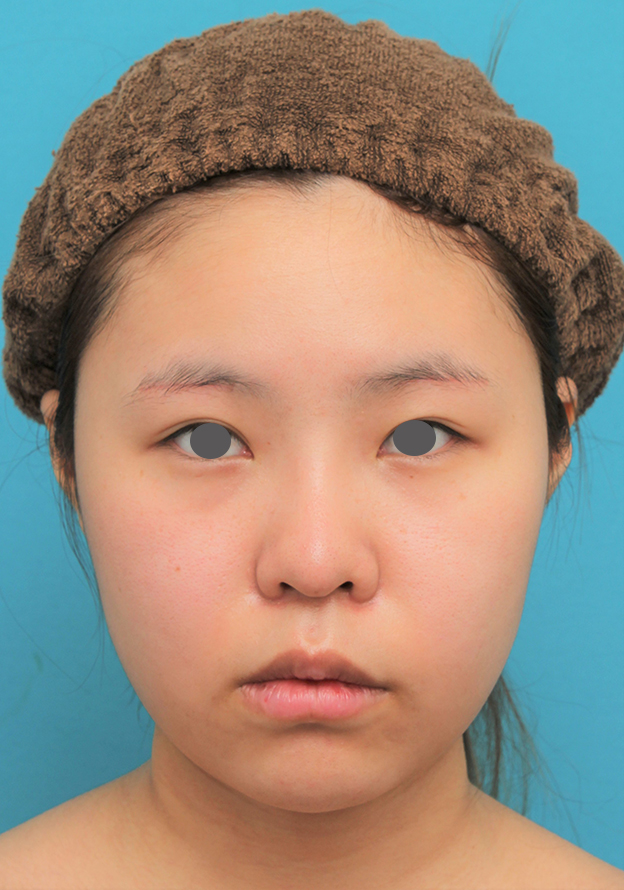 脂肪吸引（頬、あご下）,顔（頬～フェイスライン～顎下）の脂肪吸引をした20代女性の症例写真,3週間後,mainpic_shibo006d.jpg