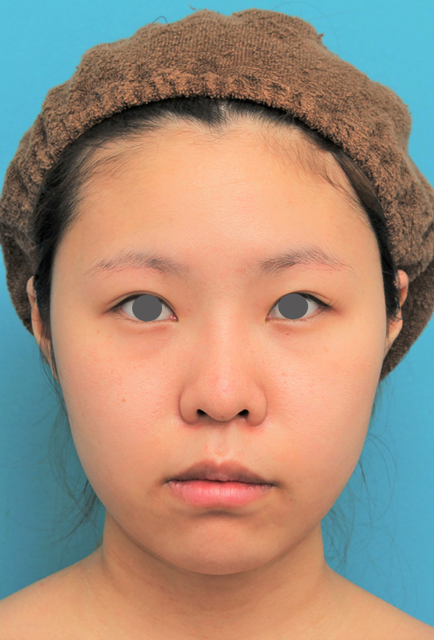 脂肪吸引（頬、あご下）,顔（頬～フェイスライン～顎下）の脂肪吸引をした20代女性の症例写真,2ヶ月後,mainpic_shibo006e.jpg