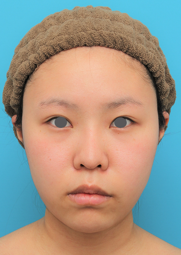 脂肪吸引（頬、あご下）,顔（頬～フェイスライン～顎下）の脂肪吸引をした20代女性の症例写真,6ヶ月後,mainpic_shibo006f.jpg