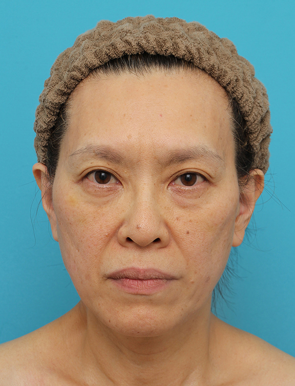症例写真,Vシェイプリフト(ヒアルロン酸注射)の症例 目の下のタルミが強い60代女性,After(1週間後),ba_v_shapelift022_b01.jpg
