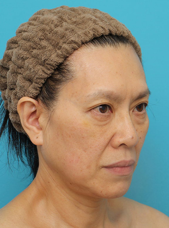 症例写真,Vシェイプリフト(ヒアルロン酸注射)の症例 目の下のタルミが強い60代女性,After(1週間後),ba_v_shapelift022_b02.jpg