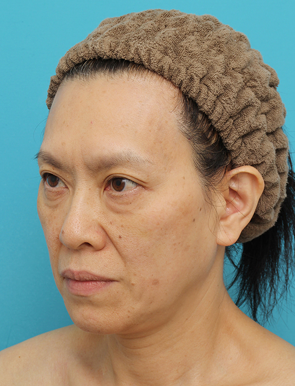 症例写真,Vシェイプリフト(ヒアルロン酸注射)の症例 目の下のタルミが強い60代女性,After(1週間後),ba_v_shapelift022_b03.jpg