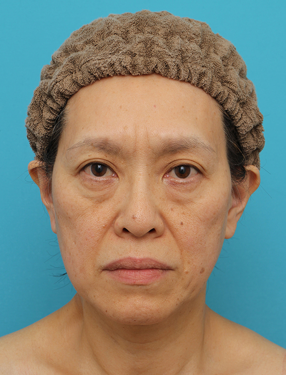 症例写真,Vシェイプリフト(ヒアルロン酸注射)の症例 目の下のタルミが強い60代女性,Before,ba_v_shapelift022_b01.jpg