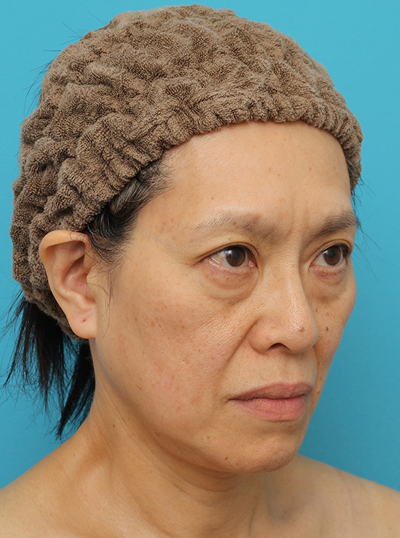 症例写真,Vシェイプリフト(ヒアルロン酸注射)の症例 目の下のタルミが強い60代女性,Before,ba_v_shapelift022_b02.jpg
