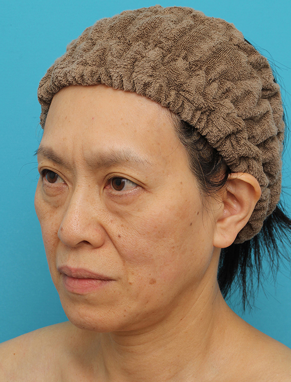 症例写真,Vシェイプリフト(ヒアルロン酸注射)の症例 目の下のタルミが強い60代女性,Before,ba_v_shapelift022_b03.jpg