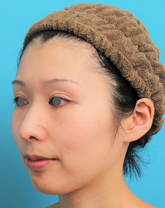 症例写真,顎にシリコンプロテーゼを入れた20代女性の症例写真,After(6ヶ月後),ba_ago022_b02.jpg