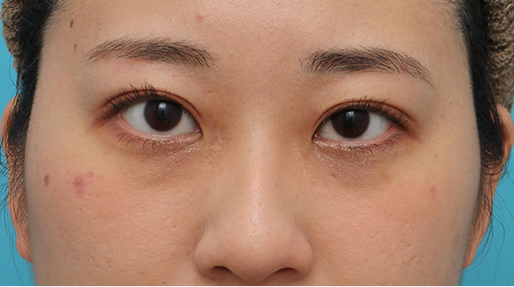 症例写真,二重まぶた・埋没法の症例 腫れぼったい一重まぶたの方も目頭切開が不要,After(メイクあり)<br/>
(1ヶ月後),