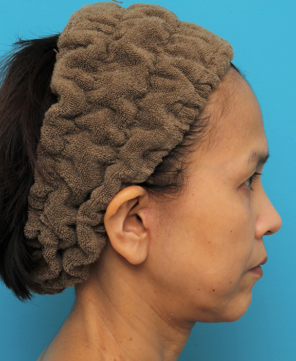 症例写真,ミディアムフェイスリフトを行った50代女性の症例写真,After(6ヶ月後),ba_mediumlift016_b02.jpg